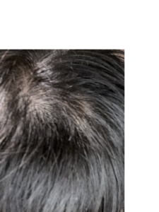 頭皮　円形脱毛症　完治　フロジン　注射　皮膚科